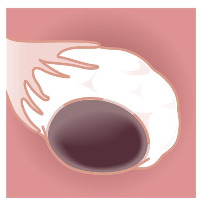 Hlboká infiltrujúca endometrióza