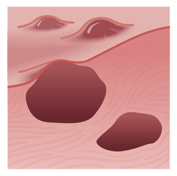 Ovariálny endometrióm