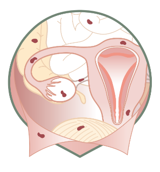 endometrioza